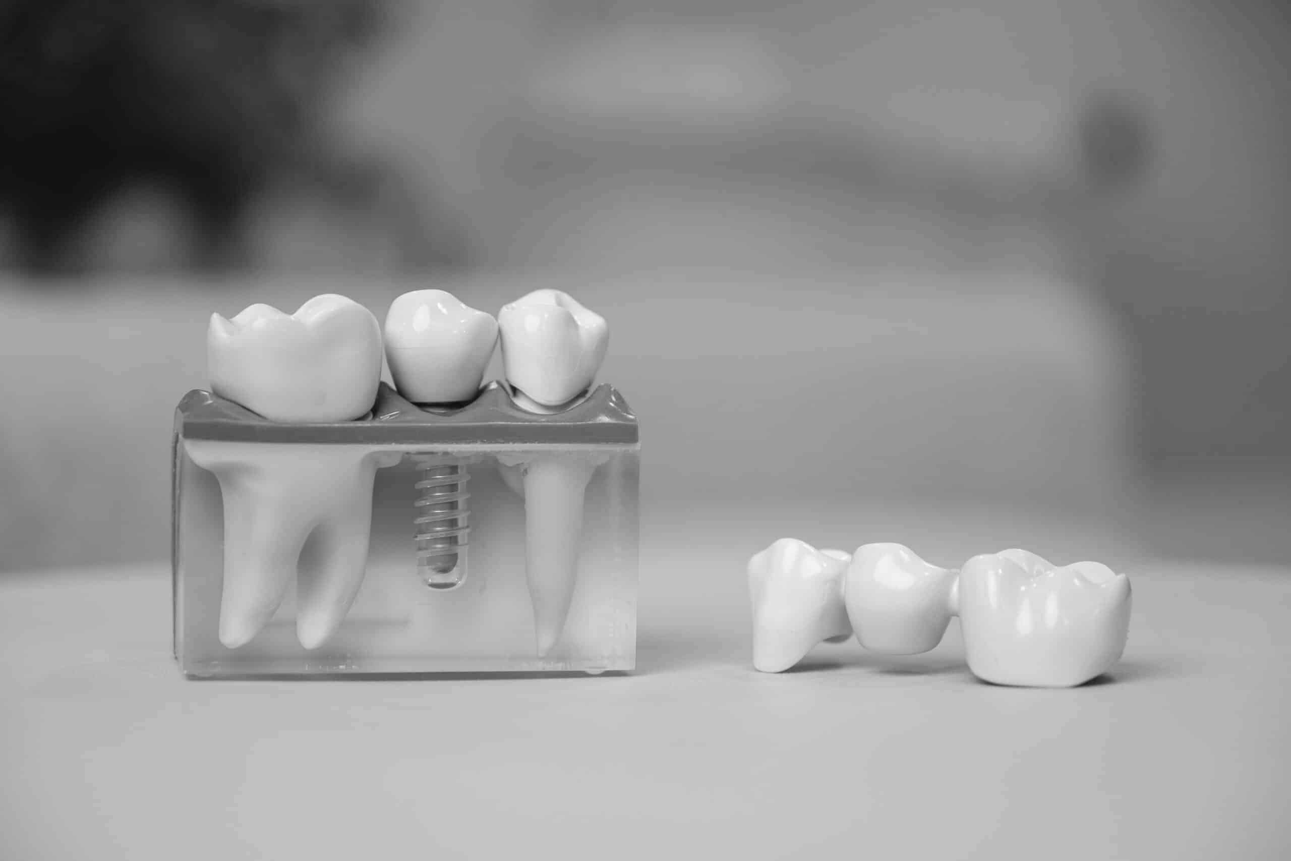 Dentalni implantati